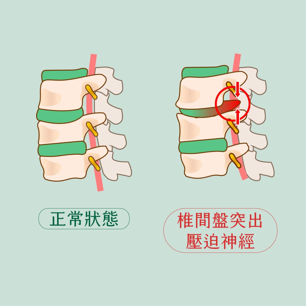 【椎間盤突出會好嗎？】症狀及成因逐一睇。