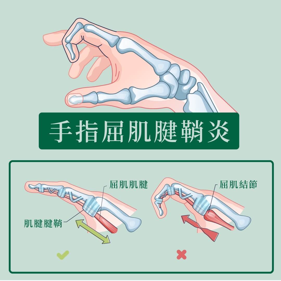 【彈弓手】看清板機指4成因、症狀,認識治療及舒緩方法。(2025年專家意見)