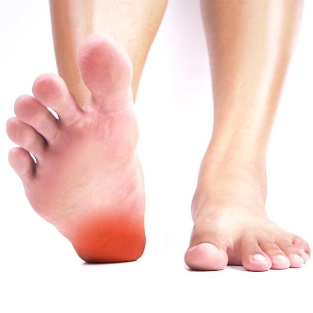 足底筋膜炎-腳踭痛原因-ANKH機能再生