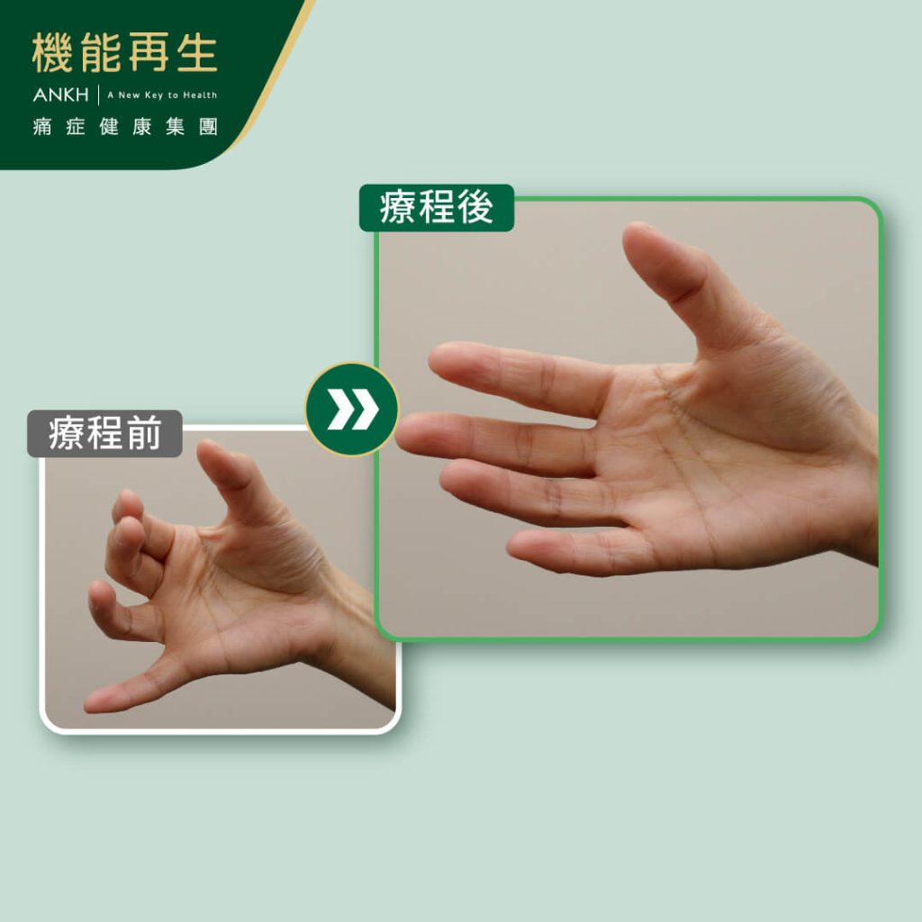 完成「RDS+極速去痛技術」療程後_手指關節變得活動自如_ANKH機能再生