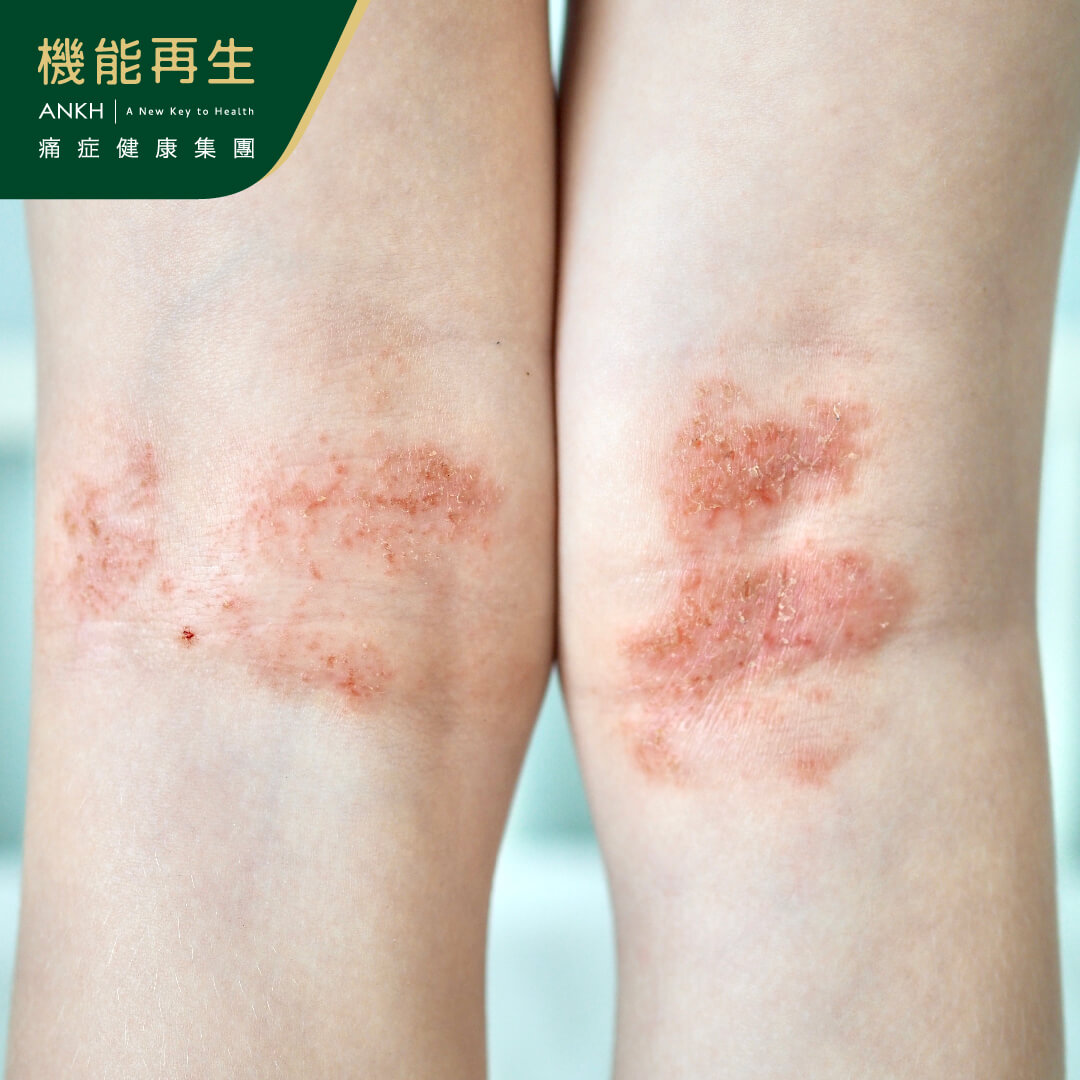 中醫【濕疹】秘笈:3類症狀、原因及5位置,飲食攻略、戒口清單推薦。(2024年專家意見)