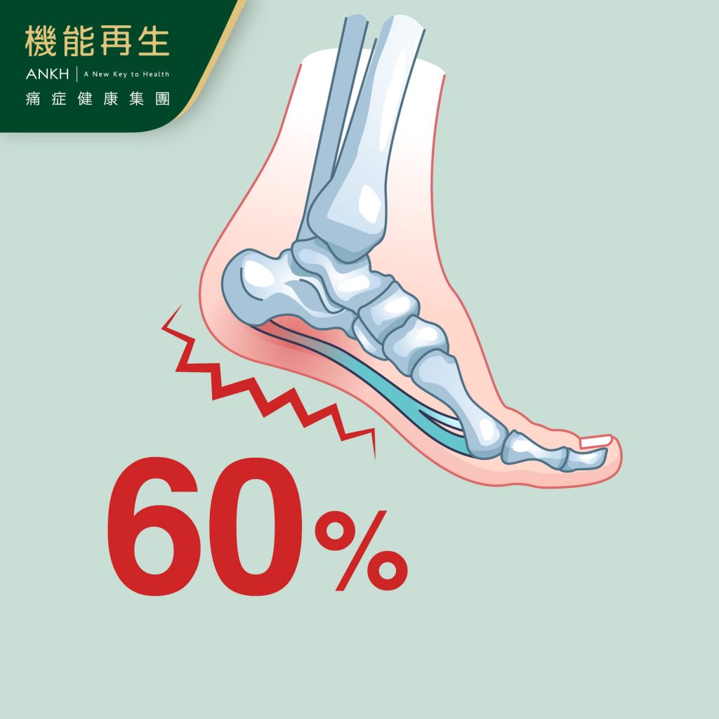 人體有60%重量壓在腳跟，是足底筋膜炎主要痛點-ANKH機能再生