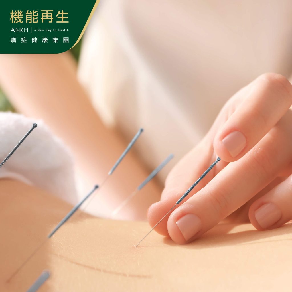 中醫師在針灸時使用的針數，按有關節筋骨痛人士個別狀況而定