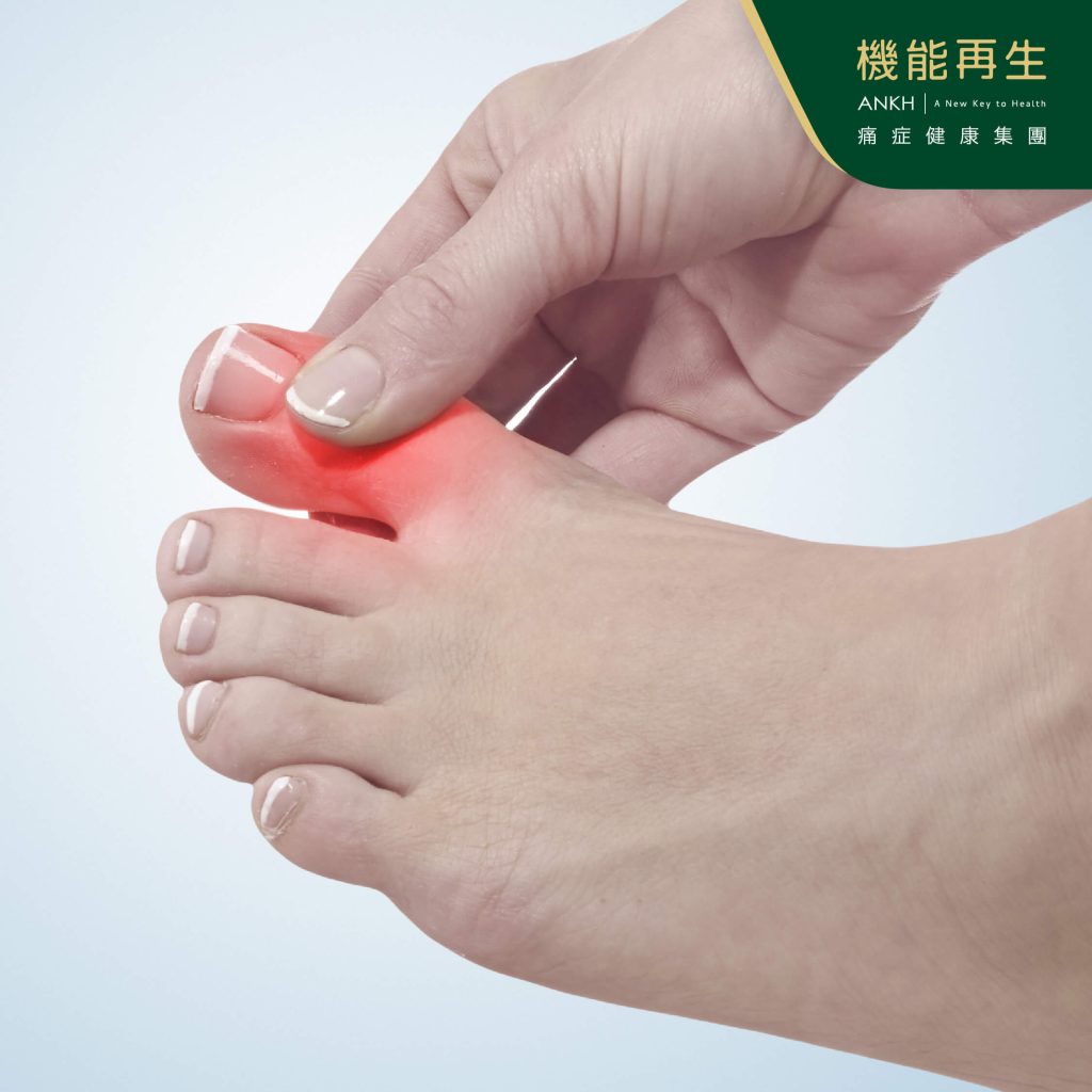 腳趾公-常見痛風位置-ANKH機能再生