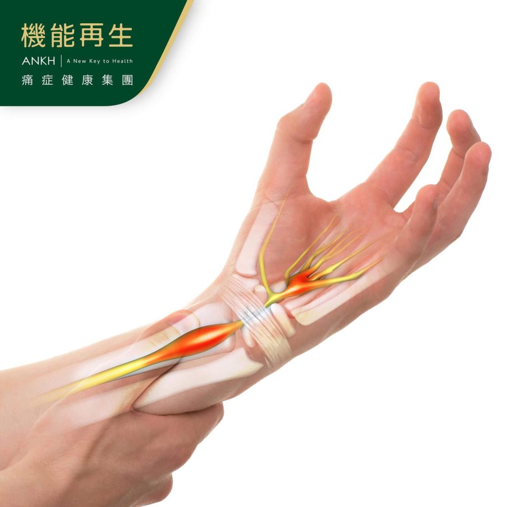 腕管綜合症是手腕痛的成因-ANKH機能再生