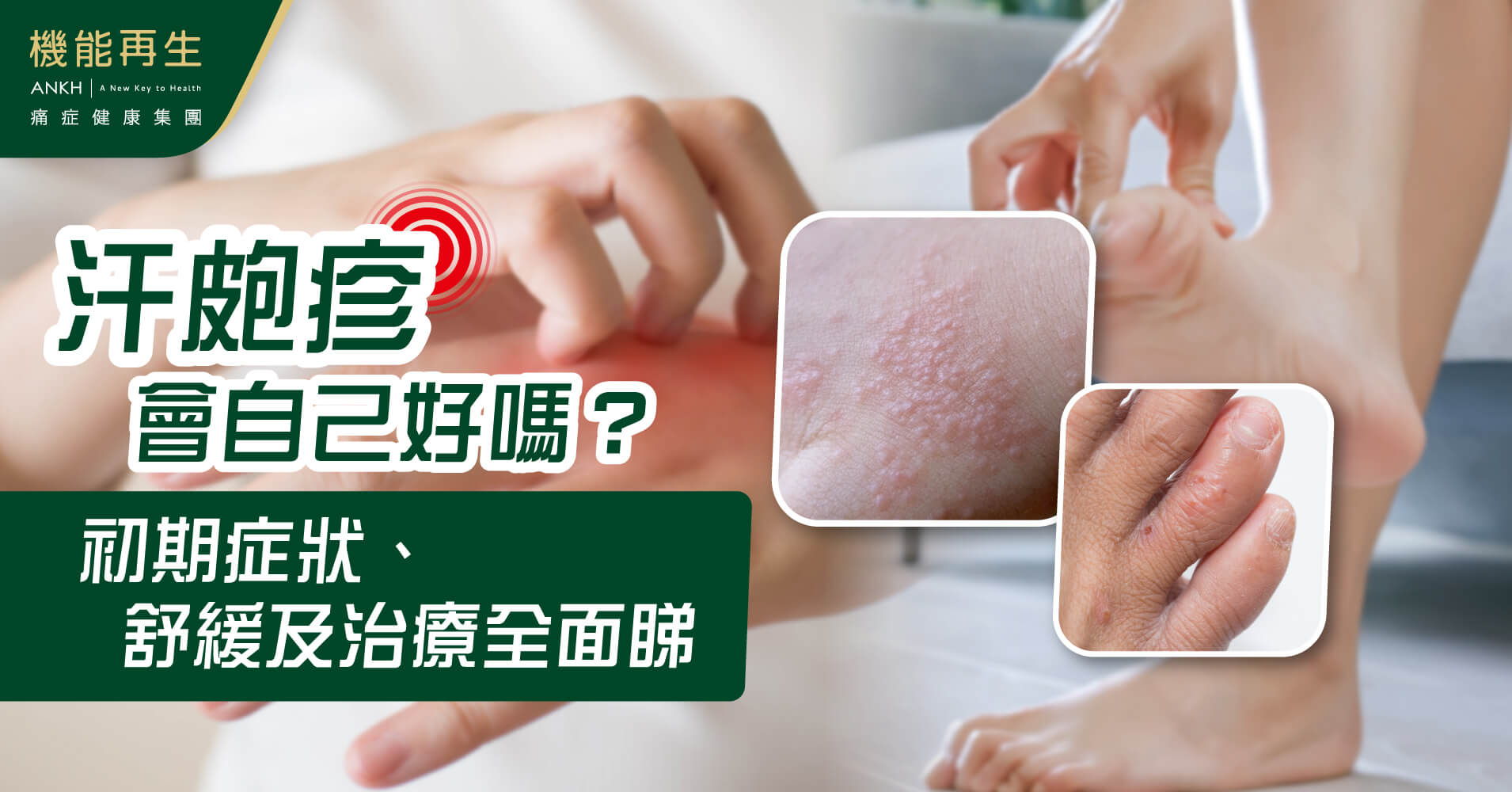 濕疹:【汗皰疹】會自己好嗎?初期症狀、舒緩及治療方法推薦全面睇。
