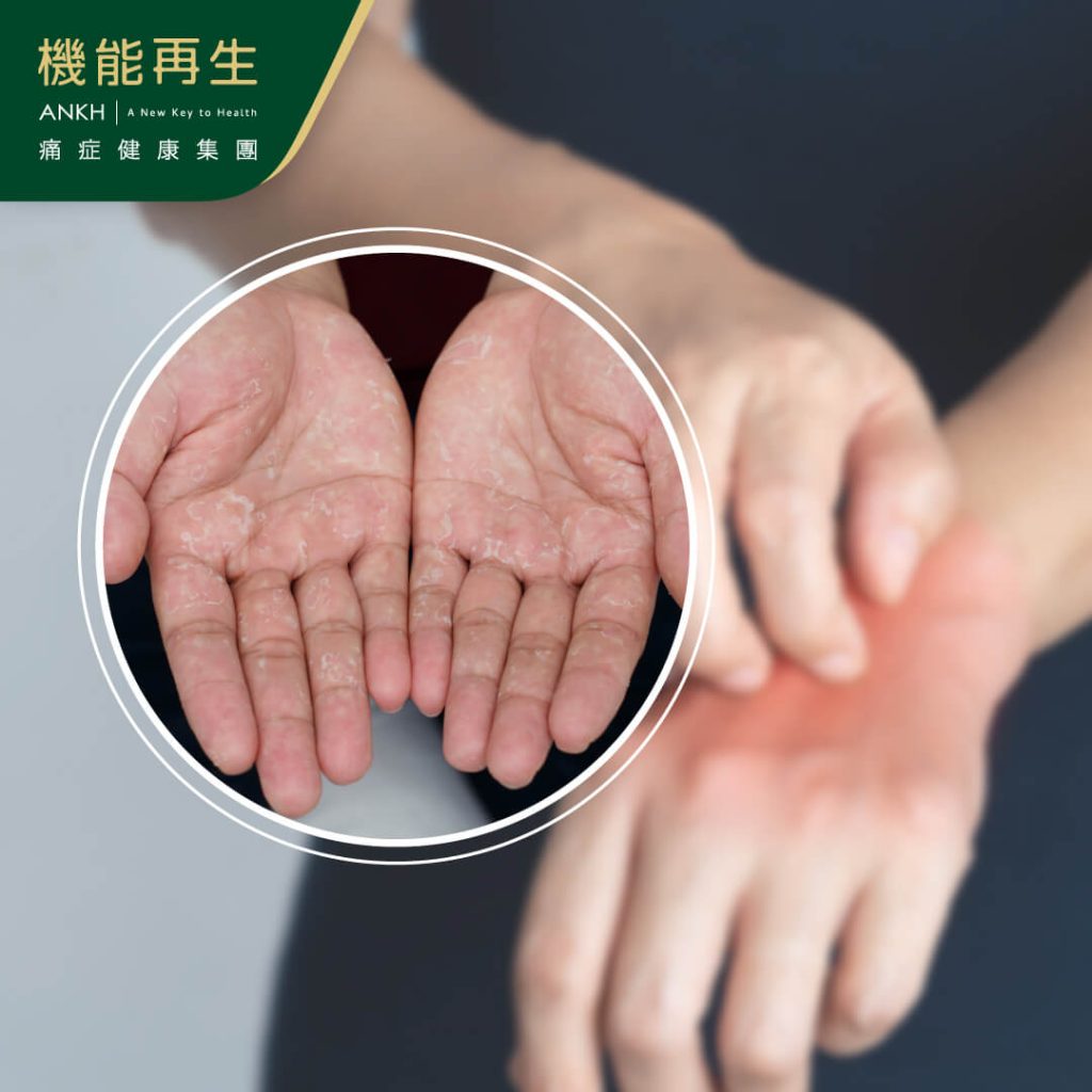 手汗疱疹佔手部濕疹約5至10%，手部乾燥是常見濕疹症狀之一