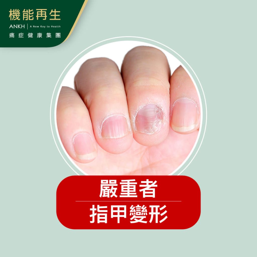 有嚴重汗疱疹，或出現指甲變形、凹凸不平