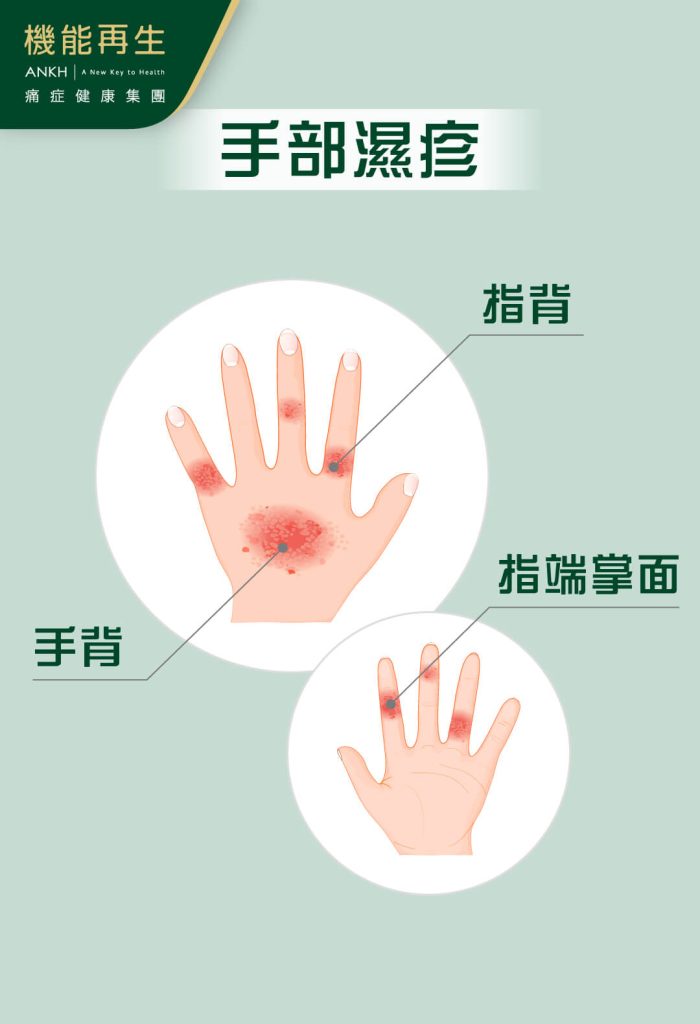 手部濕疹可以遍布手背、指背、指端掌面及腋下。