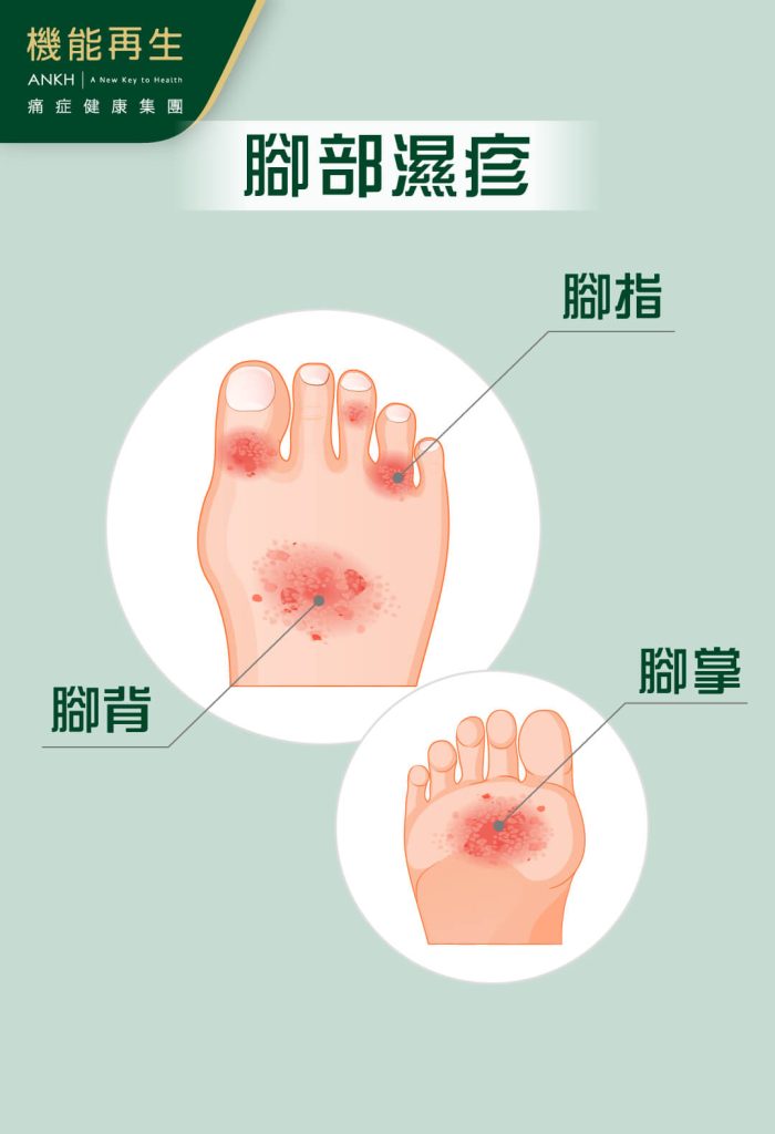 腳部濕疹可遍布腳指、腳背及腳掌