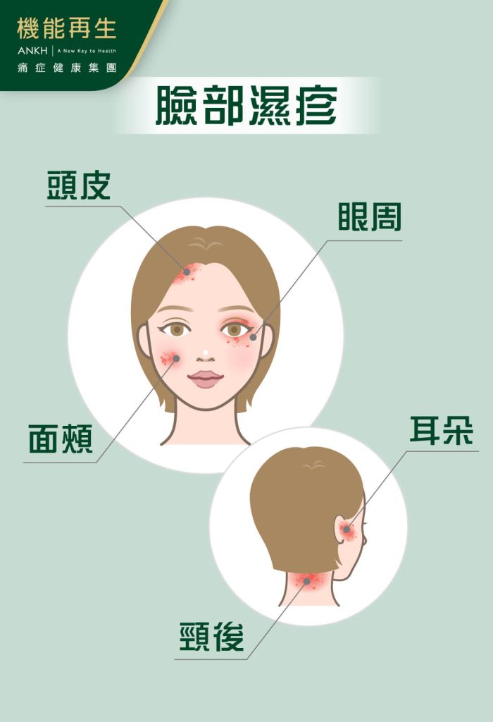 臉部不同位置都可能出現濕疹，包括頭皮、眼周、臉頰、頸後、耳部