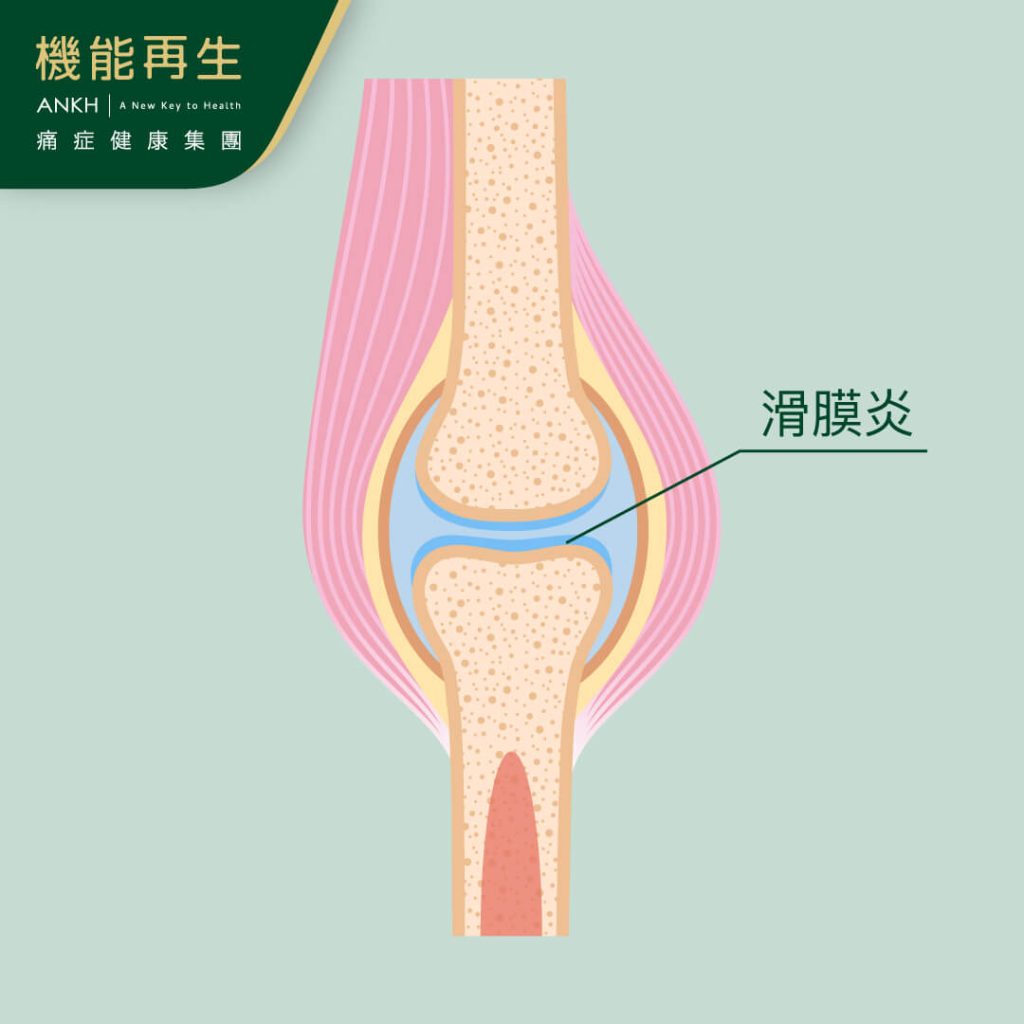 滑膜具潤滑關節功能，一旦膝蓋滑膜發炎，會造成膝蓋腫痛-ANKH機能再生