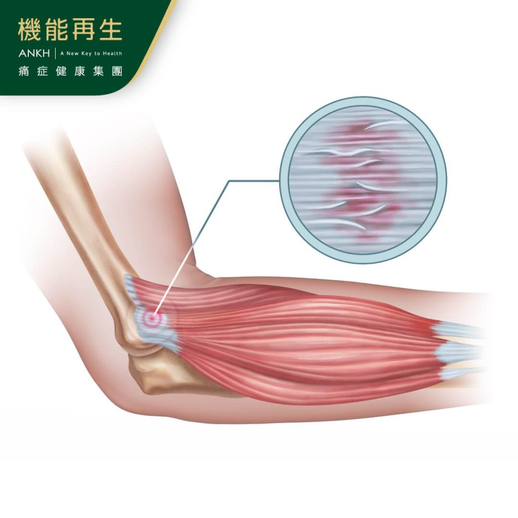 網球手與過度使用手腕伸肌有關-ANKH機能再生