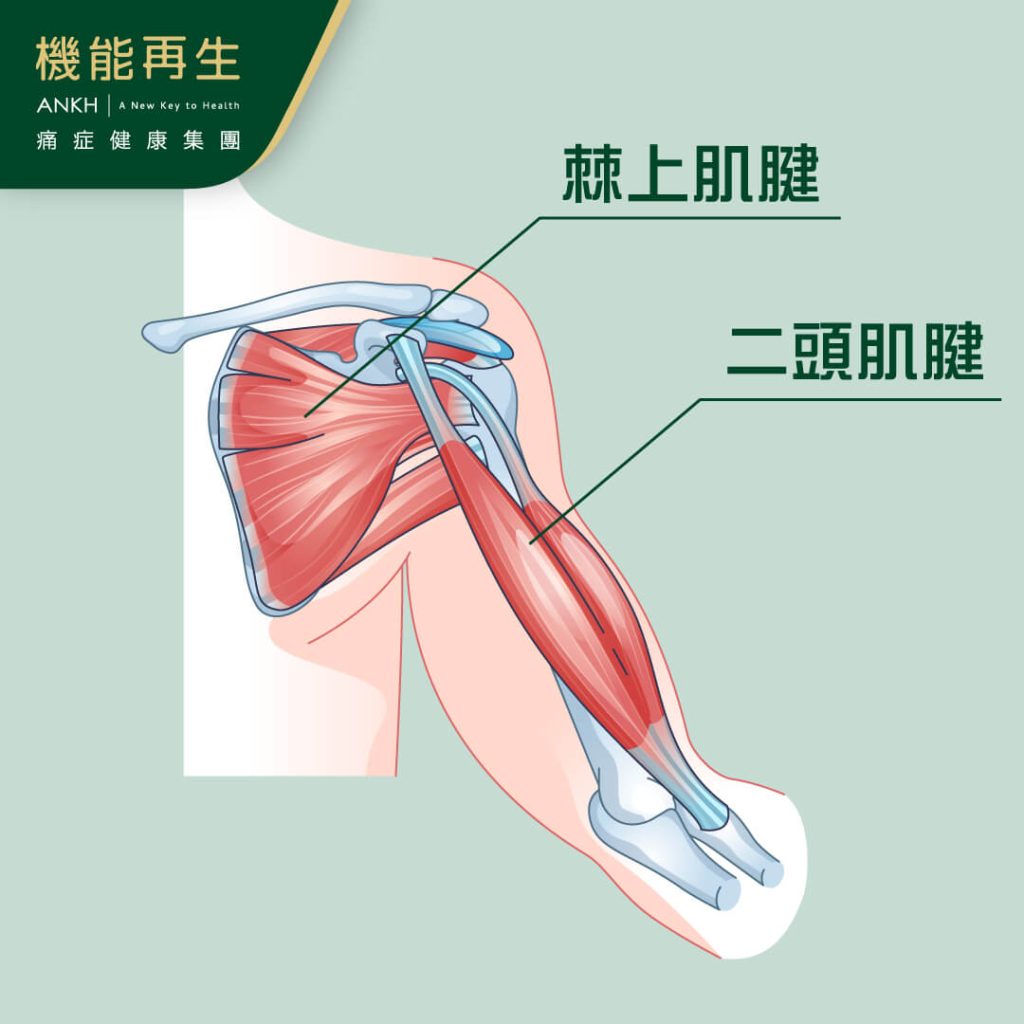 鈣化性肌腱炎常見於棘上肌腱或二頭肌腱-ANKH機能再生