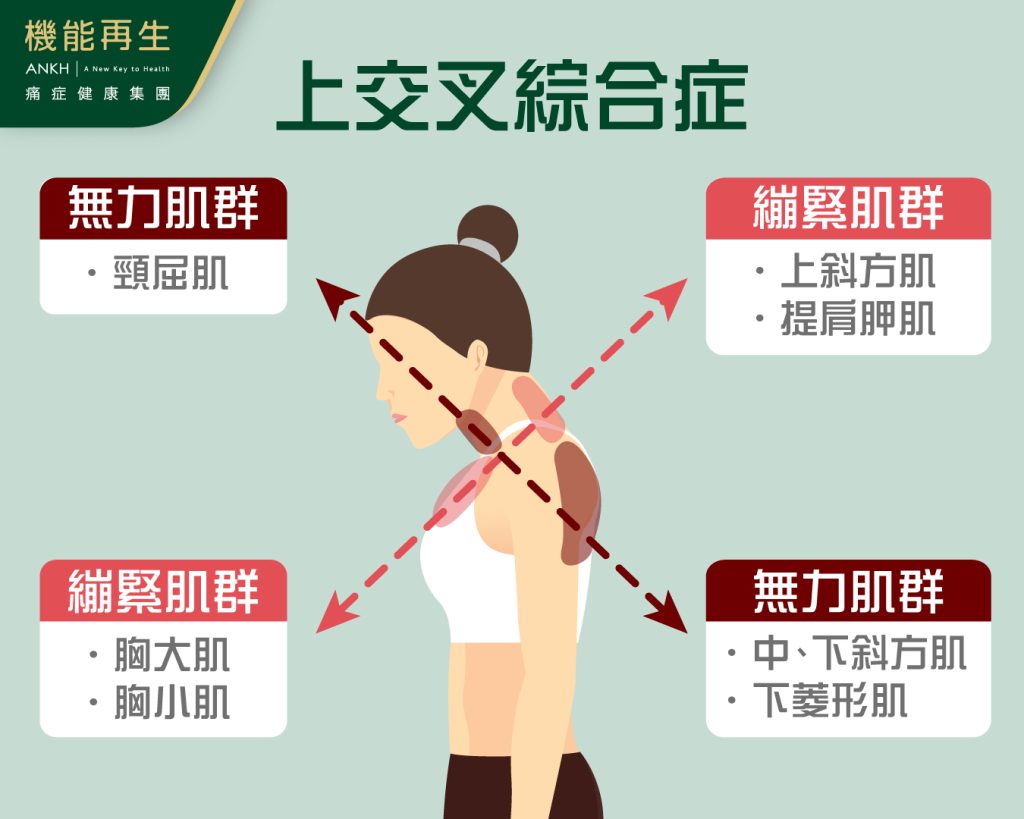 因繃緊的肌肉和無力的肌肉形成了一個交叉，故稱為「上交叉綜合症」。